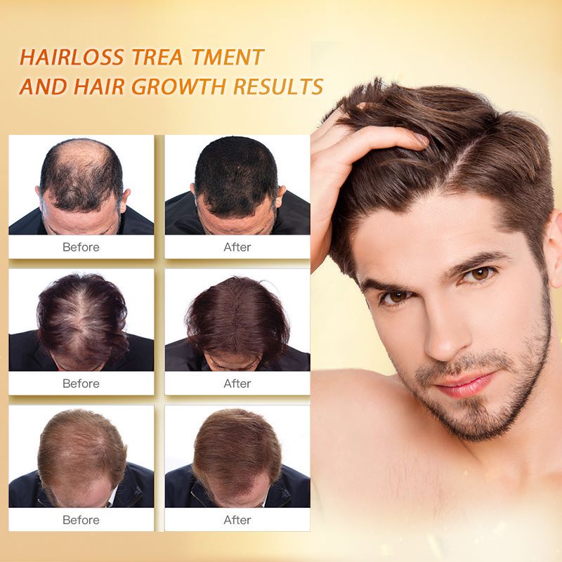 Hair Growth Prevent Hair Loss Essential Oil